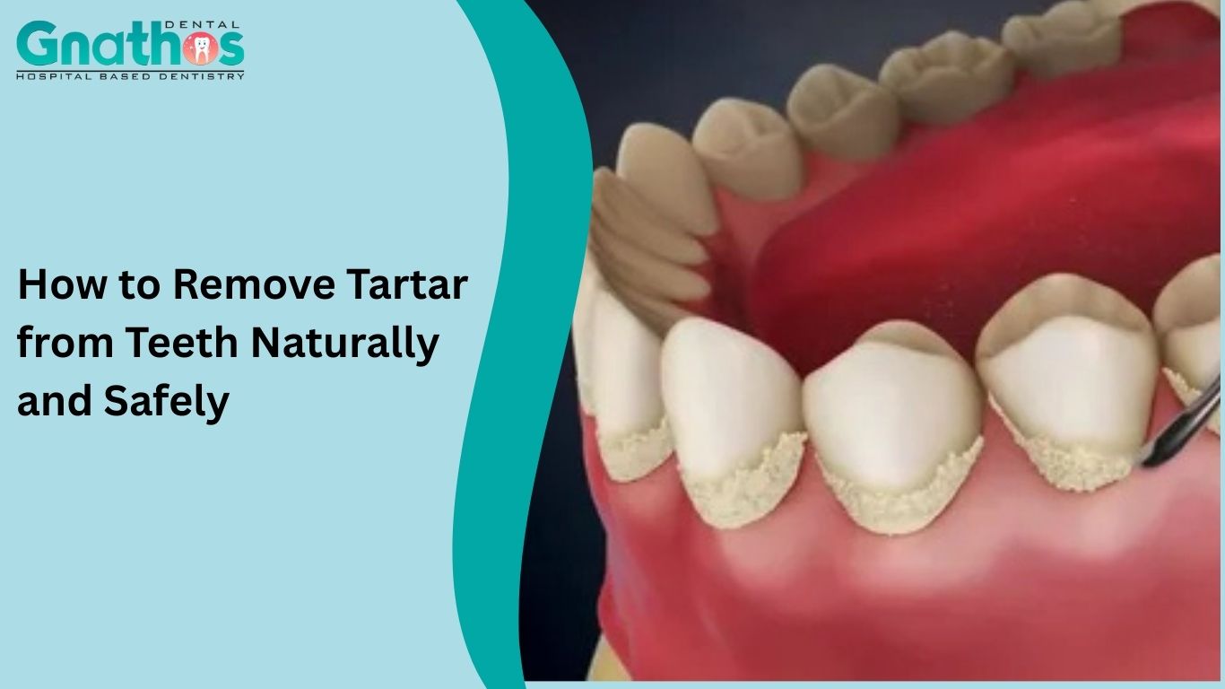 How to Remove Tartar from Teeth Naturally