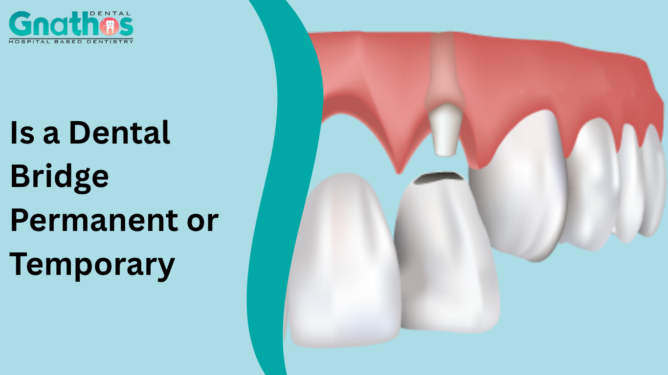 Is a Dental Bridge Permanent