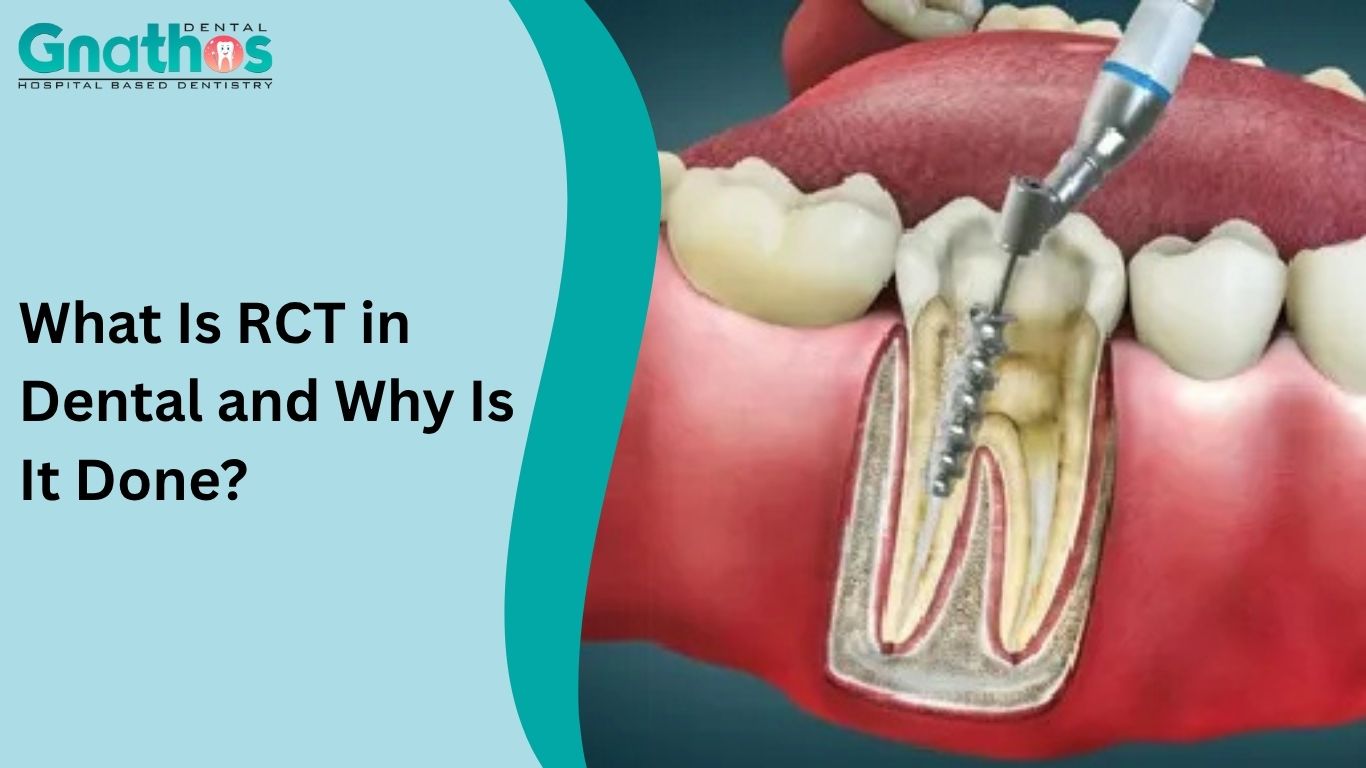 What Is RCT in Dental
