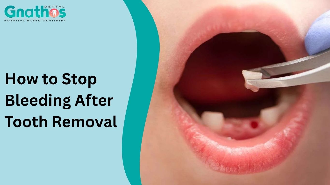How to Stop Bleeding After Tooth Removal​
