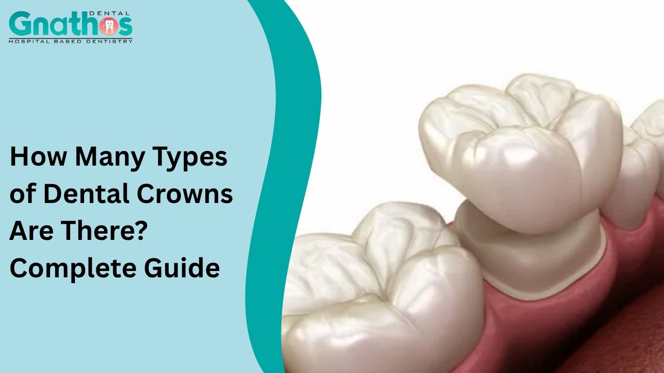 Types of Dental Crowns